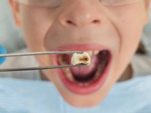 Best Dental Abscess Treatment in Clinton, IA