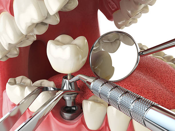 Best Emergency Dental Care for Sports Injuries in Clinton, IA